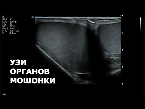 Видео: Алгоритм проведения УЗИ органов мошонки
