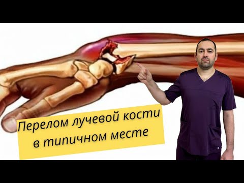 Видео: Перелом руки: перелом лучевой кости | Fracture of the arm: fracture of the radius