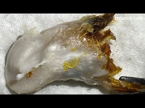 Видео: 1559 - Удаление обтурирующего кератоза II степени