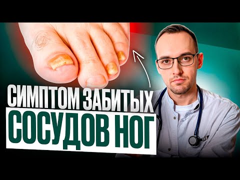 Видео: 5 ПРИЗНАКОВ ЗАБИТЫХ СОСУДОВ НОГ. Как проверить дома без врача?