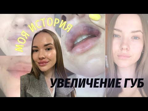 Видео: УВЕЛИЧЕНИЕ ГУБ | моя история | архивные фото до и после