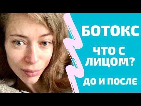 Видео: Ботокс: побочки, криворукий врач, до и после