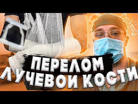 Видео: ПЕРЕЛОМ ЛУЧЕВОЙ КОСТИ | Репозиция, Гипс, Разработка Лучезапястного Сустава