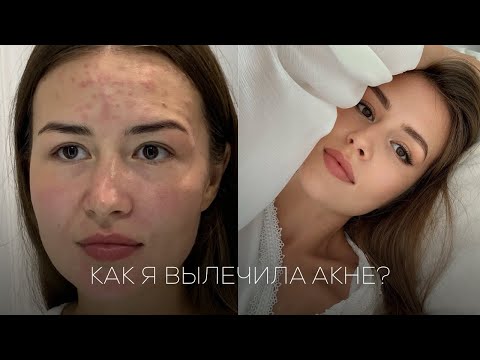 Видео: КАК Я ВЫЛЕЧИЛА АКНЕ? моя история