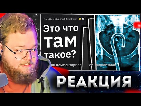 Видео: T2X2 СМОТРИТ: Врачи Рассказывают о ХУДШИХ Травмах из-за Ceк$@ #2