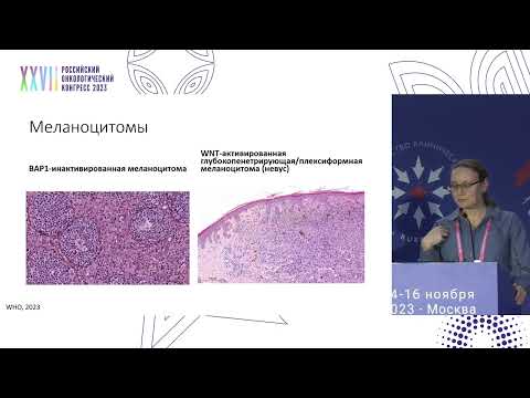 Видео: Меланома: классификация ВОЗ 2023