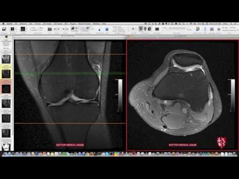 Видео: Систематическая интерпретация МРТ коленного сустава: дополнительные случаи