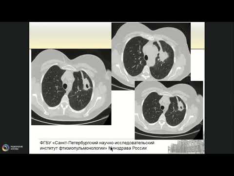 Видео: Туберкулез и рак легкого на примере клинических случаев