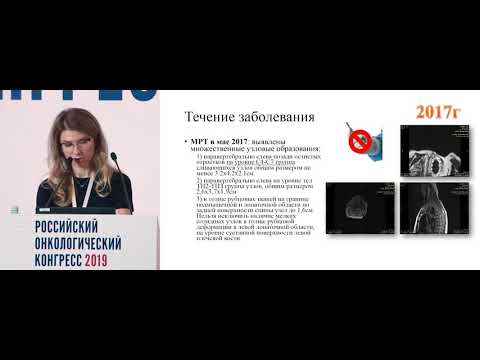 Видео: Комбинированное лечение пациента с местно-распространенной саркомой мягких тканей спины