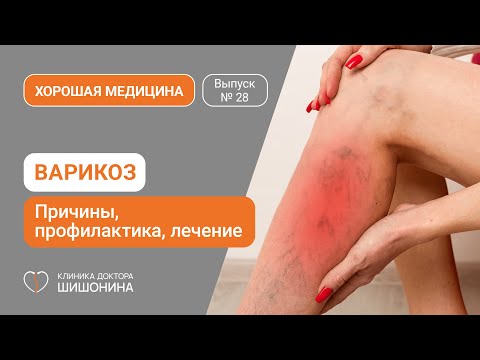 Видео: Варикоз: причины, профилактика, лечение / «Хорошая медицина» с хирургом-флебологом ❤️