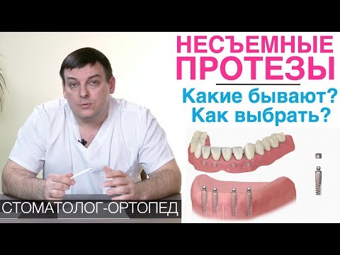 Видео: Несъемные зубные протезы: какие бывают и как выбрать несъемный протез для зубов? Зубные мосты и др.