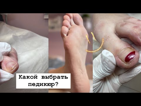Видео: ПЕДИКЮР /Аппаратный или препаратный / Какую выбрать технику в педикюре? Подногтевые мозоли |Трещины