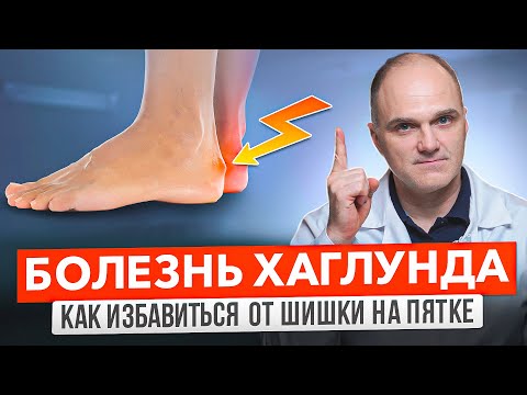 Видео: Шишка на пятке (деформация Хаглунда): почему появляется и как лечить? | Травматолог Банецкий Максим