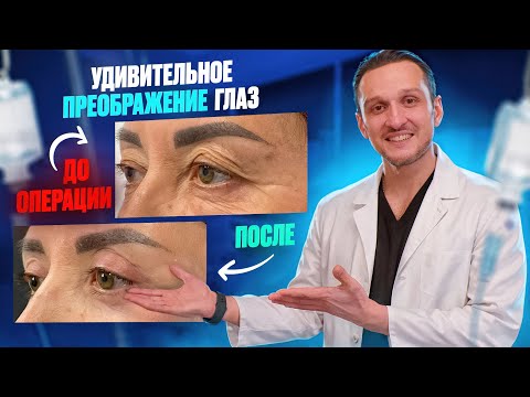 Видео: ПОСМОТРИ прежде , чем СДЕЛАТЬ! | БЛЕФАРОПЛАСТИКА