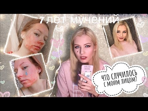 Видео: ЧТО ПРОИЗОШЛО С МОИМ ЛИЦОМ? АКНЕ, ПРОБЛЕМЫ С КОЖЕЙ ЛИЦА. Как справиться с проблемами на коже