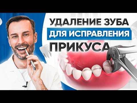 Видео: Удаления зуба для исправления прикуса. Реальный пример в клинике OrthoLike