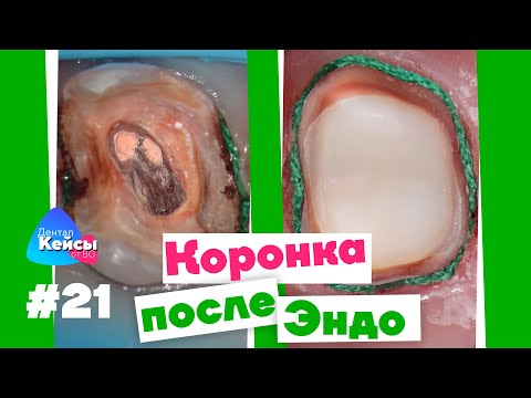 Видео: Коронка после Эндо  | Дентал Кейсы от BG #21