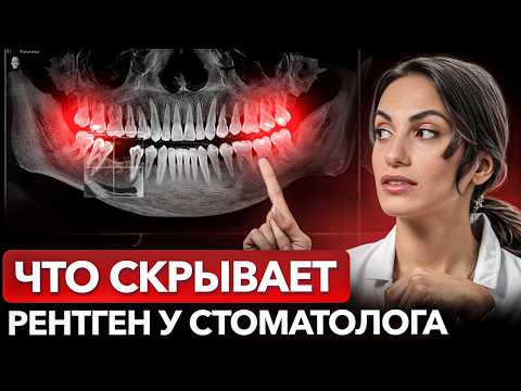 Видео: Стоматолог в ШОКЕ: разбор реального снимка пациента / Как вылечить зубы, если всё запущено?