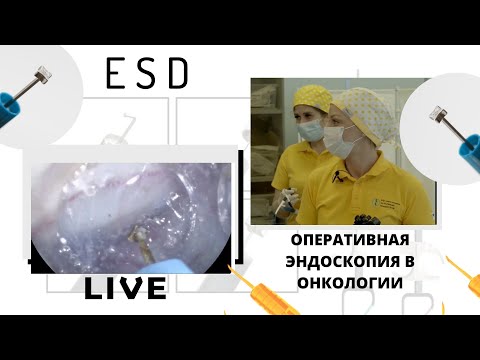 Видео: Прямая трансляция из НМИЦ онкологии им. Н. Н. Петрова. Эндоскопическая подслизистая диссекция