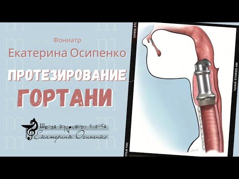 Видео: Протезирование, как метод формирования голоса после, по поводу рака гортани. СОВЕТЫ ФОНИАТРА