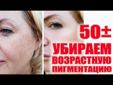 Видео: Пигментные пятна убрать реально! Профилактика и средства!
