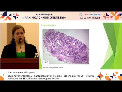 Видео: Клинико-морфологические особенности ангиосарком молочной железы, трудности диагностики.
