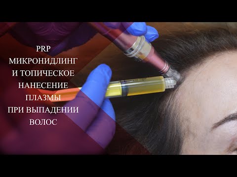 Видео: 💉ТОП ПРОЦЕДУРА! PRP волос и Микронидлинг +Аутоплазма  топически