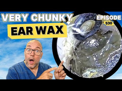 Видео: Очень густая ушная сера! Эпизод 530