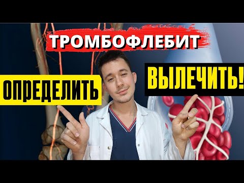 Видео: Тромбофлебит глубоких и поверхностных вен | Симптомы Лечение