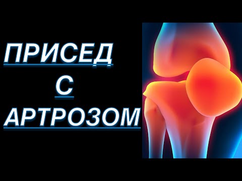 Видео: ПРИСЕДАНИЯ С АРТРОЗОМ КОЛЕННОГО СУСТАВА 3 СТЕПЕНИ | Доктор Юршин