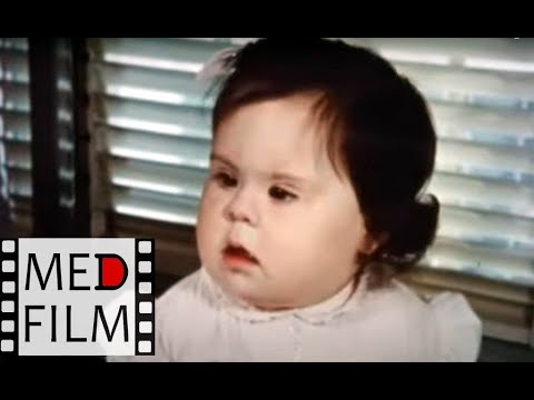 Видео: Синдром Дауна ©