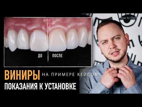 Видео: Показания для установки виниров. Что можно исправить с помощью виниров?