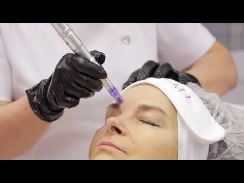 Видео: Фракционная мезотерапия. Программа подготовки кожи к агрессивным косметическим процедурам