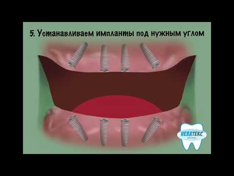 Видео: All on 4 имплантация - что это такое? Этапы, что включено в стоимость протезирования на 4 имплантах.