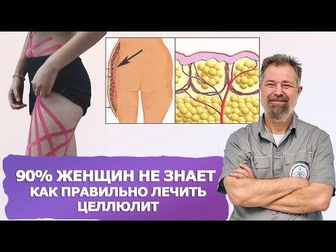 Видео: Целлюлит: медицинская проблема, а не косметический дефект! Разбираем научный подход
