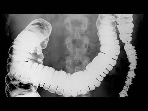 Видео: ИРРИГОСКОПИЯ. Кому подойдет этот метод исследования? О всех плюсах и минусах-в моем видео!
