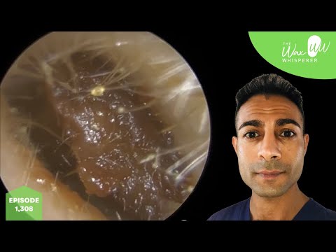 Видео: 1308 — Невероятное извлечение большой ушной серной пробки с помощью крючка для заушника