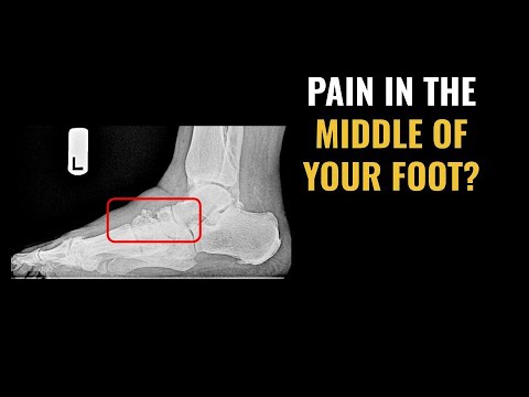 Видео: Почему болит верхняя часть стопы?