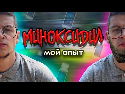 Видео: Миноксидил результаты за 72 дня