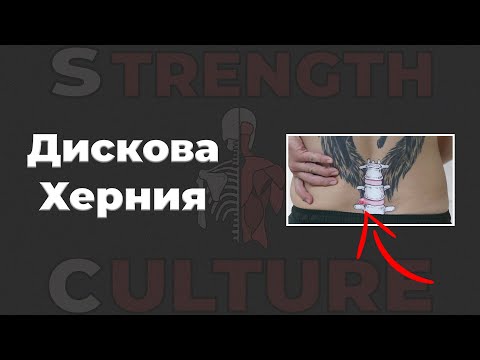 Видео: Как да се справим с дискова херния