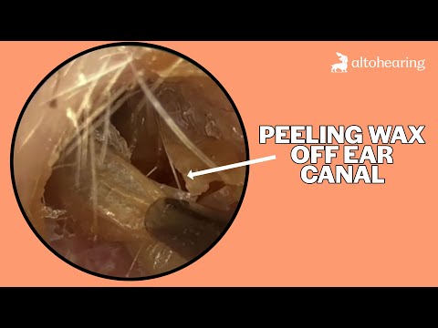 Видео: Очистка ушного канала