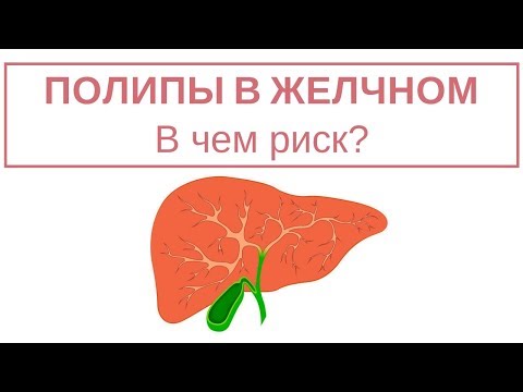Видео: ПОЛИПЫ в желчном пузыре. Не ждите!
