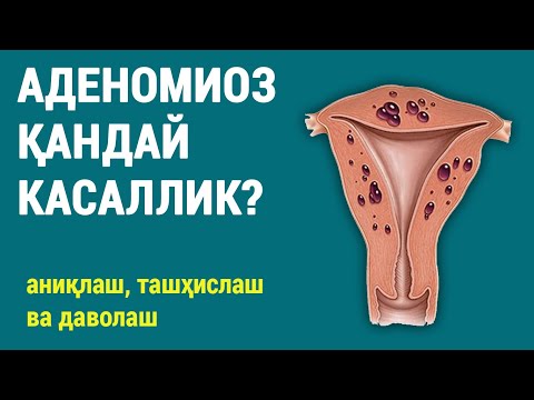 Видео: Аденомиоз қандай касаллик? Аниқлаш, ташҳислаш ва даволаш.