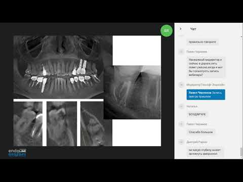 Видео: Endo.Education Вебинар Евгения Платонова "Альтернатива в обработке корневых каналов зуба"