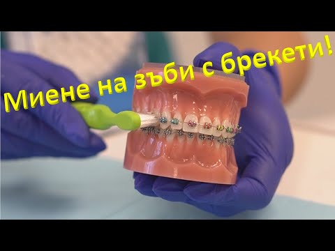 Видео: Устна хигиена с брекети! Какво ви очаква, когато имате брекети?