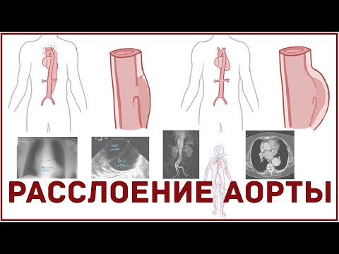 Видео: Расслоение аорты - причины, симптомы, диагностика, лечение - кратко