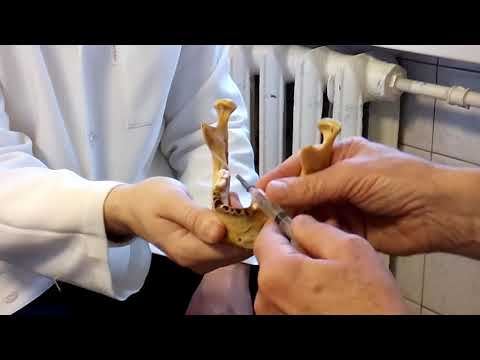 Видео: Мандибулярная анестезия (аподактильный метод)