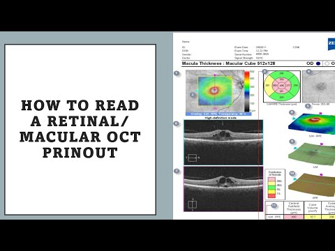 Видео: КАК ЧИТАТЬ РАСПЕЧАТКУ МАКУЛЯРНОГО ОКТ-ДИАГНОЗА? Это просто!!