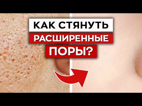 Видео: Как бороться с расширенными порами? / Как ухаживать за жирной кожей лица?