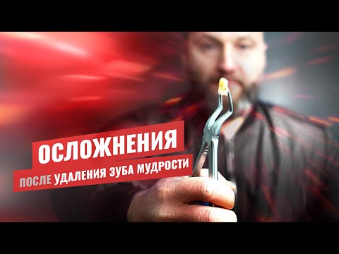 Видео: 🇺🇦 Удалили зуб мудрости, какие могут быть осложнения